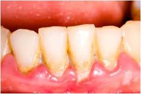 Periodontal Disease Picture